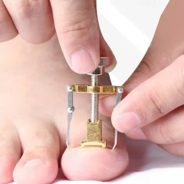 2Pcs Ingrown Toenails Corrector Stainless Steel Nail Straightening Tool Relief Pain Pedicure Tool For Ingrown Toenail Recover