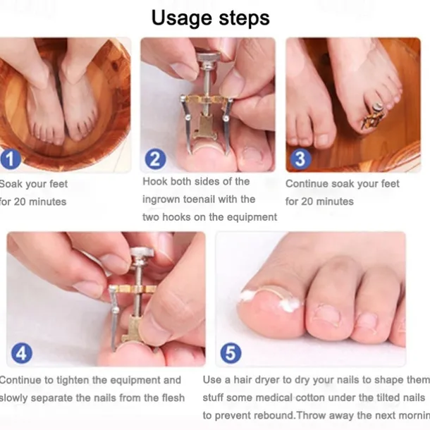 2Pcs Ingrown Toenails Corrector Stainless Steel Nail Straightening Tool Relief Pain Pedicure Tool For Ingrown Toenail Recover